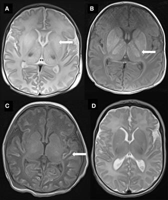 Raised Plasma Neurofilament Light Protein Levels Are Associated with Abnormal MRI Outcomes in Newborns Undergoing Therapeutic Hypothermia